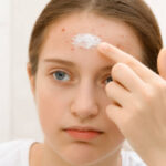 Acne treatment in Islamabad