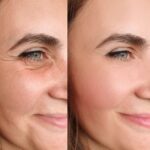 Eye Bag Removal in Islamabad: Your Path to a Youthful Appearance