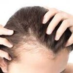 Navigating Hair Loss Solutions in Islamabad: A Comprehensive Guide