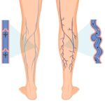 Varicose Veins Laser Treatment Clinic in Lucknow