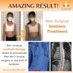 Comfort and Confidence with ScolioAlign™ 3D: Spine Brace For Scoliosis