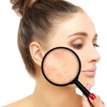 Unveiling the Journey to Smooth Skin: Effective Acne Scar Treatments