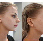 Before and After: Jawline Filler and Cheek Filler Transformations in 2024