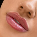 How Much Does Lip Enhancement Cost in Dubai?