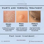 Barefoot Bliss: Bespoke Warts and Verruca Therapy in Brighton