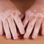 Dermatologist Guide on Vitiligo – Symptoms, Causes and Treatments