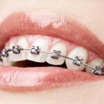 Why Choose South Miami Orthodontist Specialists Of Florida For Your Orthodontic Needs?