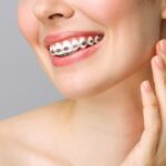 Unveiling the Journey: A Comprehensive Guide to Dental Braces