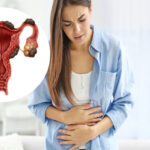 6 Common Signs of Endometriosis