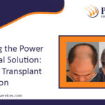 Unveiling The Power Of Natural Solution FUE Hair Transplant In Gurgaon