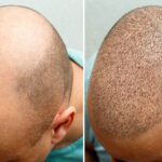 The Pros and Cons of a Royal Hair Transplant