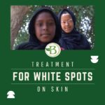 Homeopathic Vitiligo Treatment: A Holistic Approach to Managing White Spots on Skin