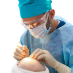 4 Steps to Find the Best Hair Transplant in Ghaziabad: Why FUE Wins