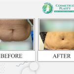 Tummy Tuck Cost in Lahore – Cosmeticoplasty
