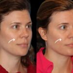 How Sculptra Injections in Dubai Compare to Traditional Fillers