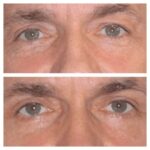 Best Eye bag removal Surgeon in dubai: Personalized Treatment Plans